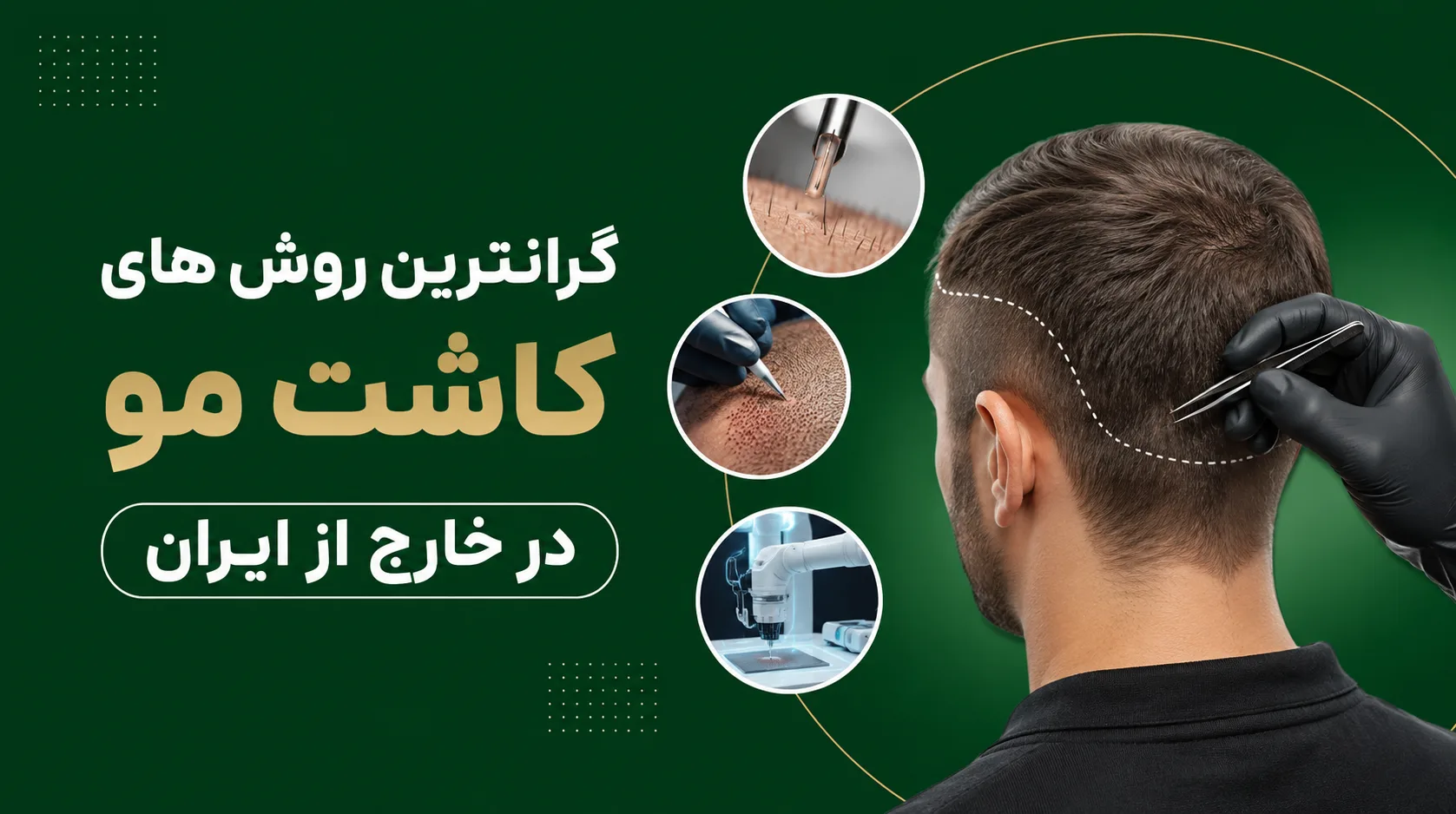 گرانترین روش های کاشت مو در خارج از ایران
